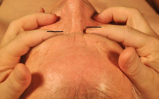 Fig. 9. Position of index fingers on the eyeballs on normal (left) side and on the affected (right) side of patient with right side CH
